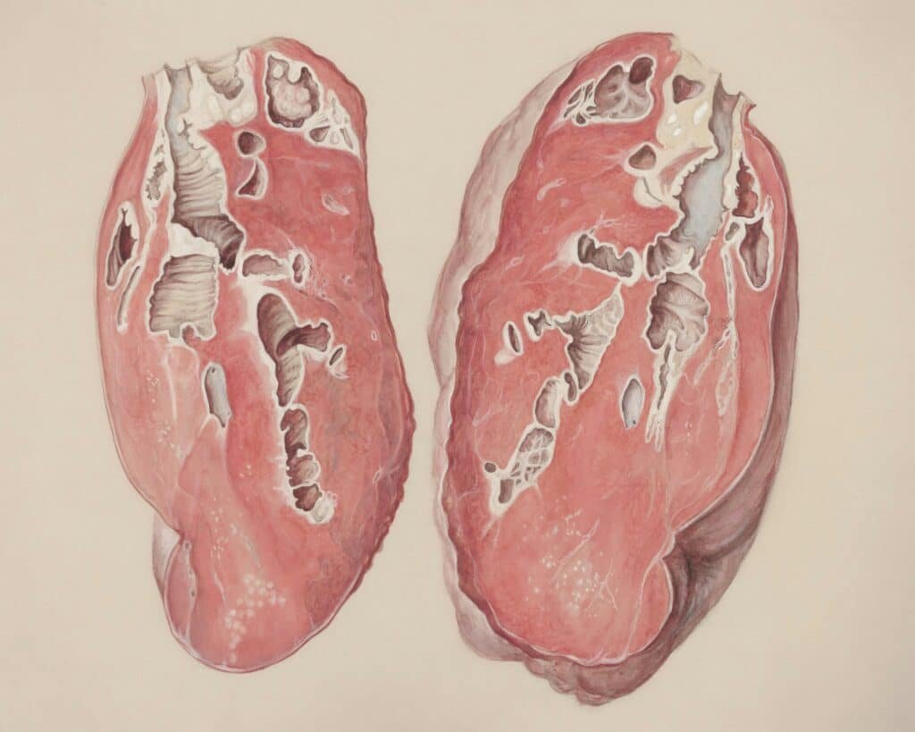 Fatty liver

